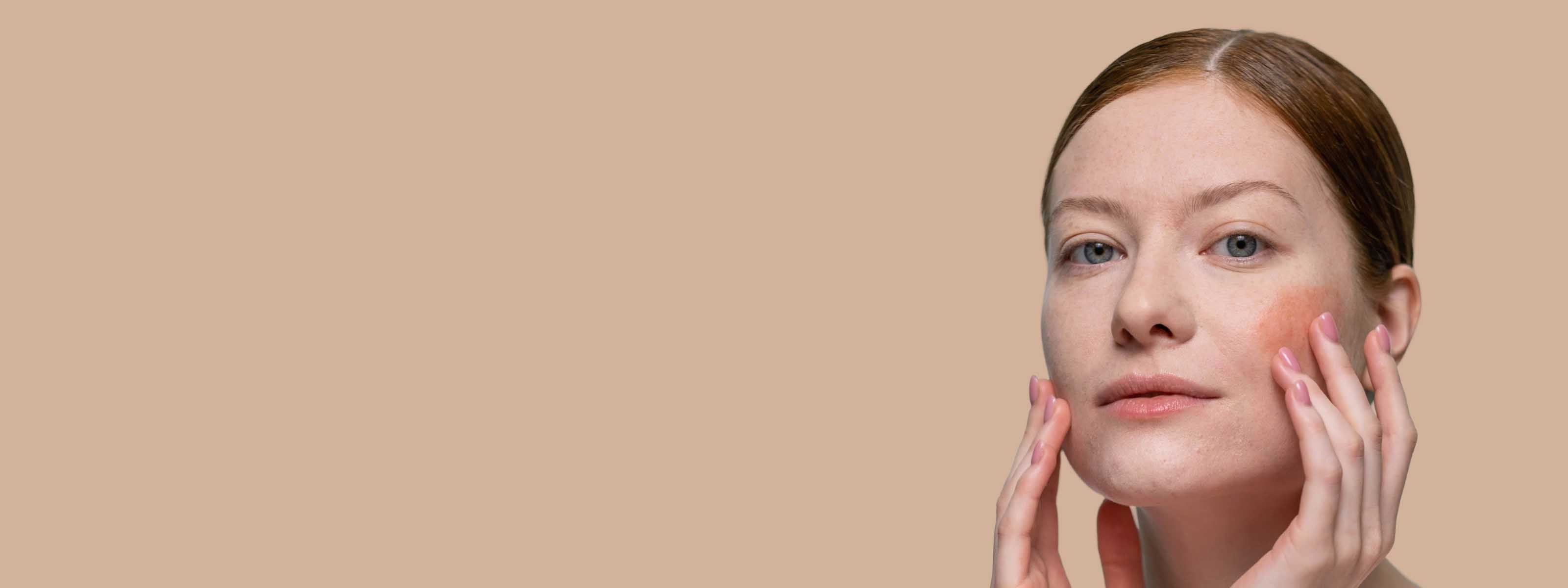 A pretty woman with brown hair is touching her face with rosacea on her cheeks