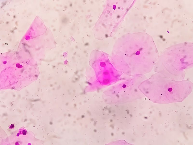 A pathology gram stain showing Bacterial Vaginosis