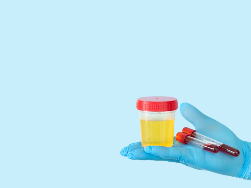 A gloved medical professional's hand holding test tubes and a urine sample cup in front of a light blue background