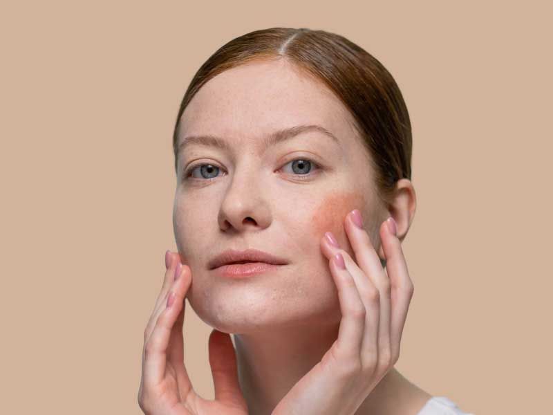 A pretty woman with brown hair is touching her face with rosacea on her cheeks