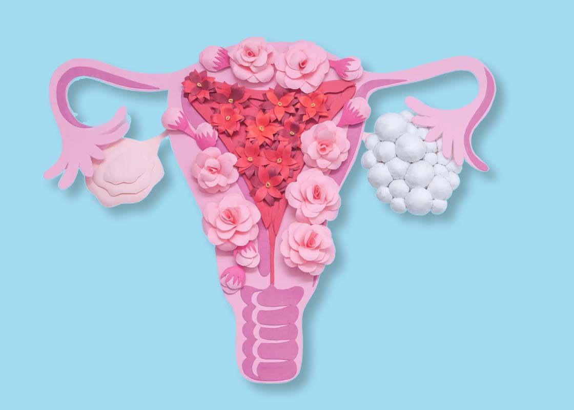 A paper cutout of a uterus and ovaries depicting PCOS on a blue surface