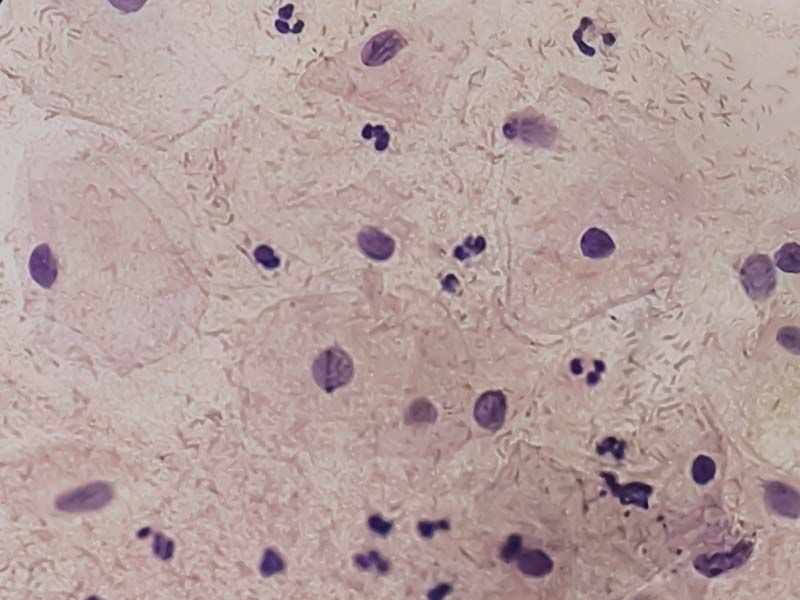 Pathology of a vaginal infection under a microscope