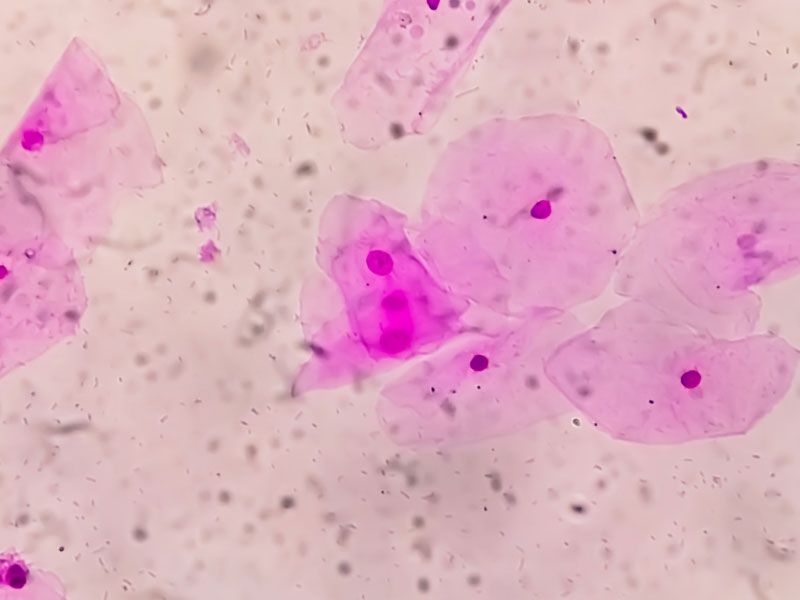 A pathology gram stain showing Bacterial Vaginosis