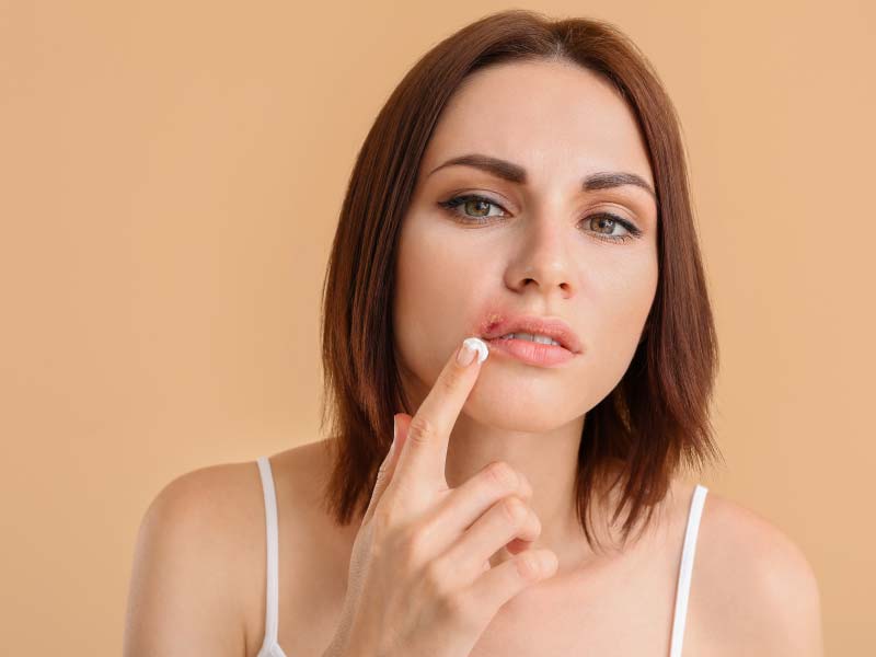 A woman with brown hair wearing a white tank top is applying cream to a cold sore on her lip
